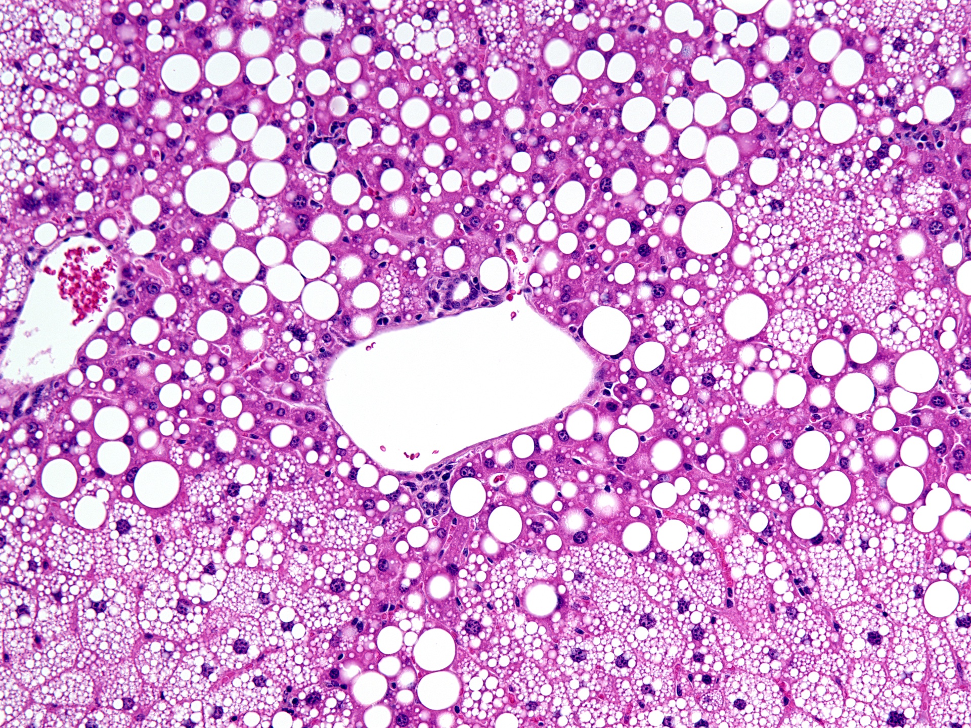 Periportal Steatosis